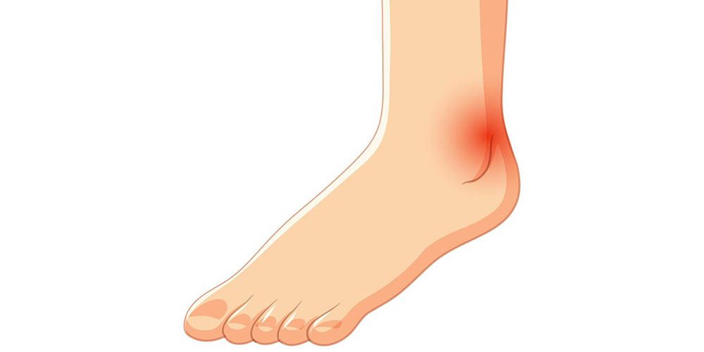 5 maneiras de prevenir lesões no tornozelo